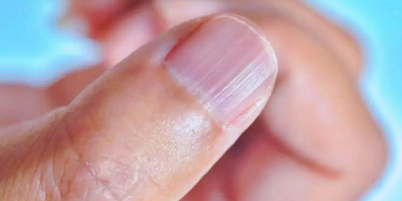 Beginner’s Guide to Treating Fingernail Ridges and Boosting Nail Health